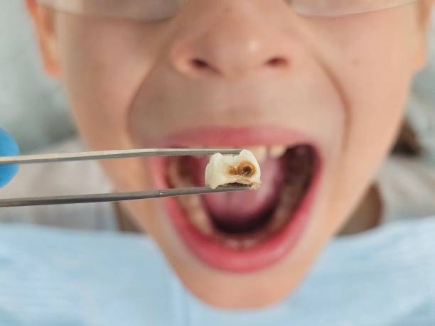 Best Emergency Tooth Extraction in Crosby, ND